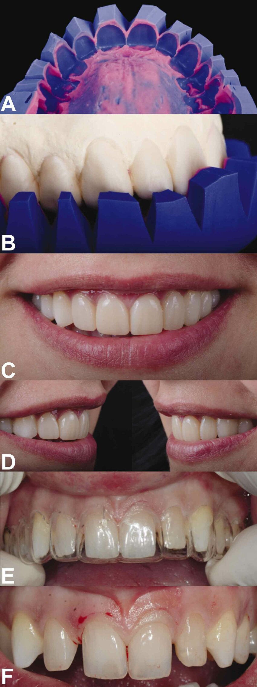 Paso a Paso: MockUp Dental: Asegura la armonía por medio de una prueba estética y funcional