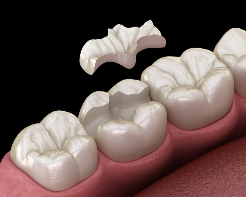 Estructura dentaria con tallado en hombro para recibir las incrustaciones dentales.