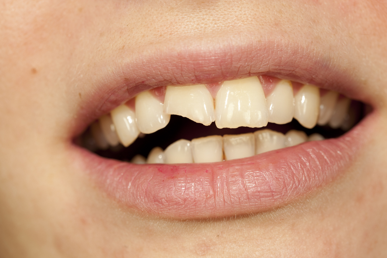 fracturas dentales