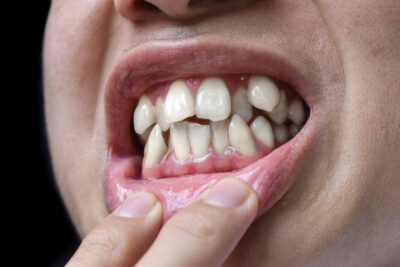 apiñamiento dental