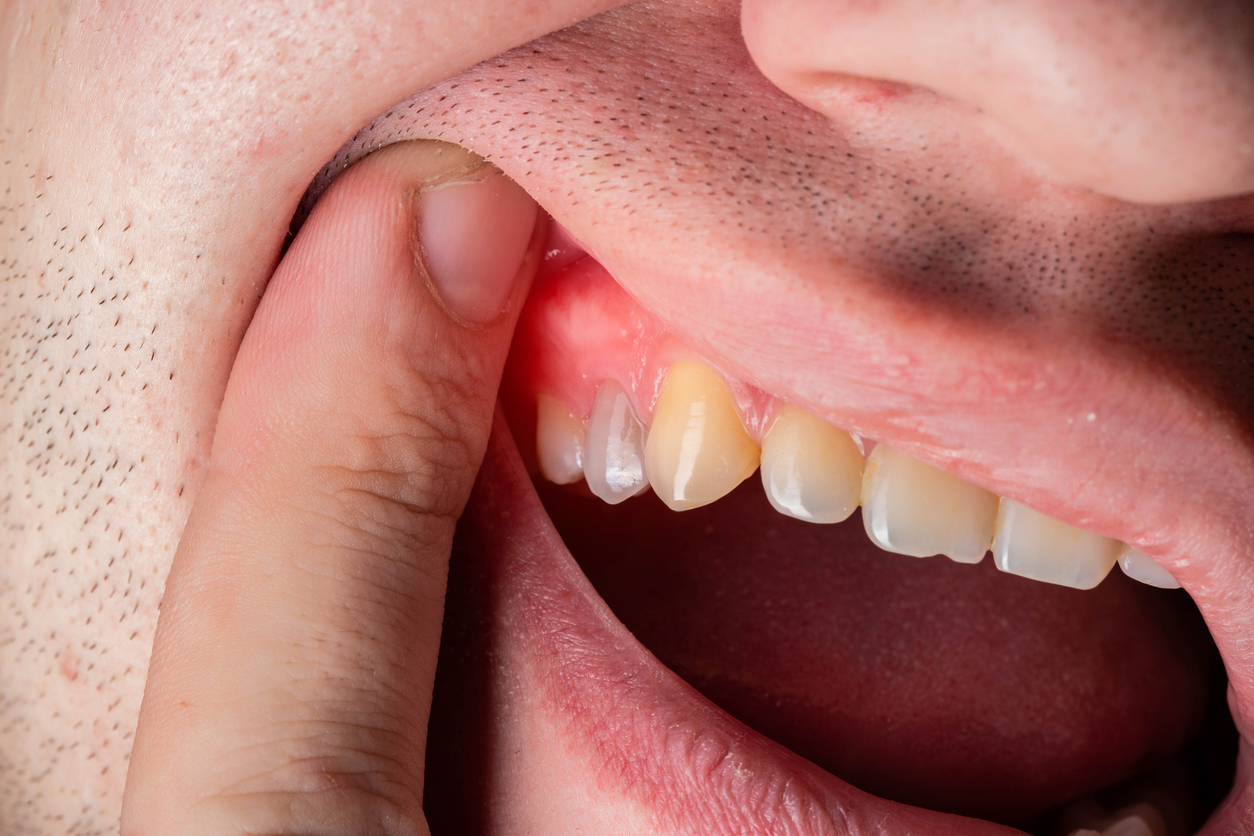 Retracción gingival