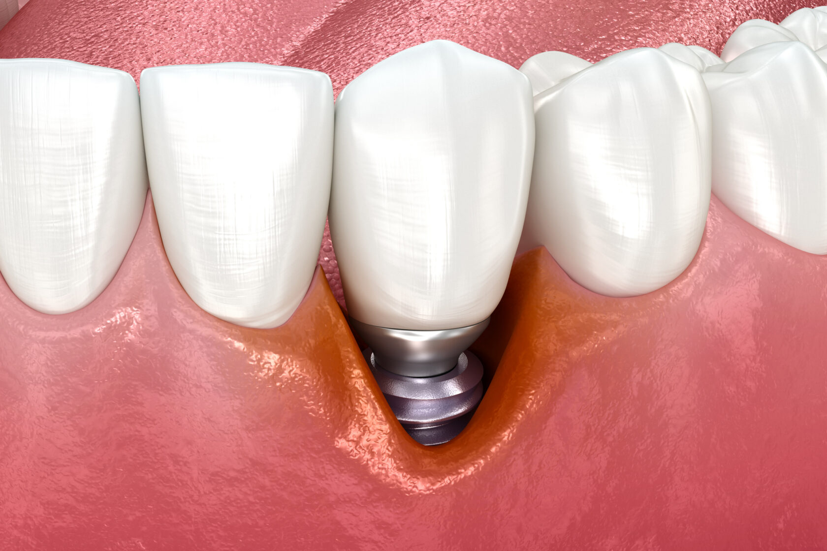 implantes dentales complicaciones largo plazo