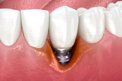 implantes dentales complicaciones largo plazo