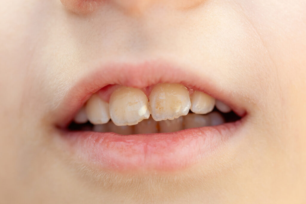 hipoplasia dental