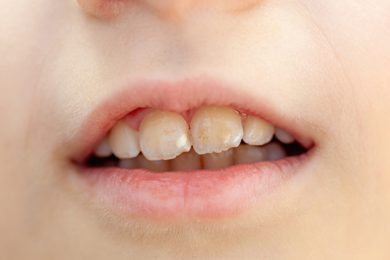 hipoplasia dental