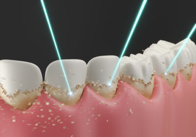 laserterapia dental