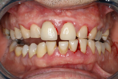¿Cómo cambia la sonrisa en un caso de periodonditis avanzada antes y después del tratamiento? Inflamed bleeding gums, sore gums, gum infection, mouth concept, health.