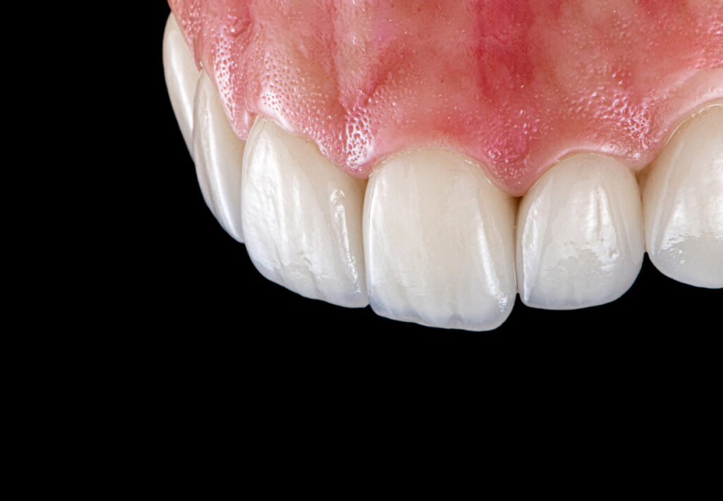 composite estratificado