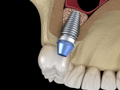¿Qué es la regeneración ósea vertical y por qué es determinante en la rehabilitación implantológica? Sinus Lift Surgery – implant installation. 3D illustration