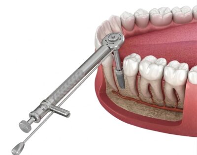 estabilidad primaria implante