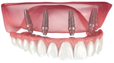 Prótesis híbrida sobre implantes: planificación, indicaciones y claves biomecánicas para el éxito clínico 0b767599-21be-44e7-917d-26f8602c4c25