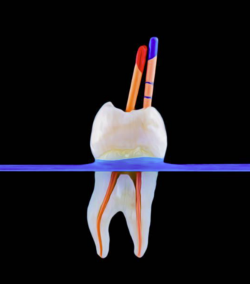 Obturación termoplástica: principios, técnica y relevancia en la endodoncia moderna Obturación termoplástica