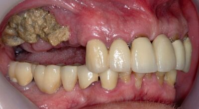 Osteonecrosis maxilar por bifosfonatos: etiopatogenia, diagnóstico y manejo clínico c7a74c8d-e327-4796-a029-24da4cccf085