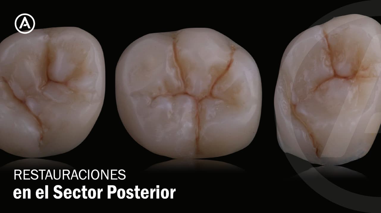 Restauraciones en el sector posterior